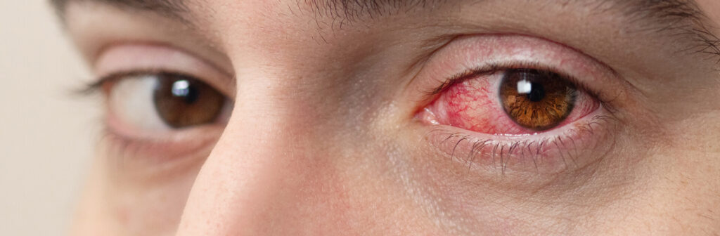 Conjuntivitis