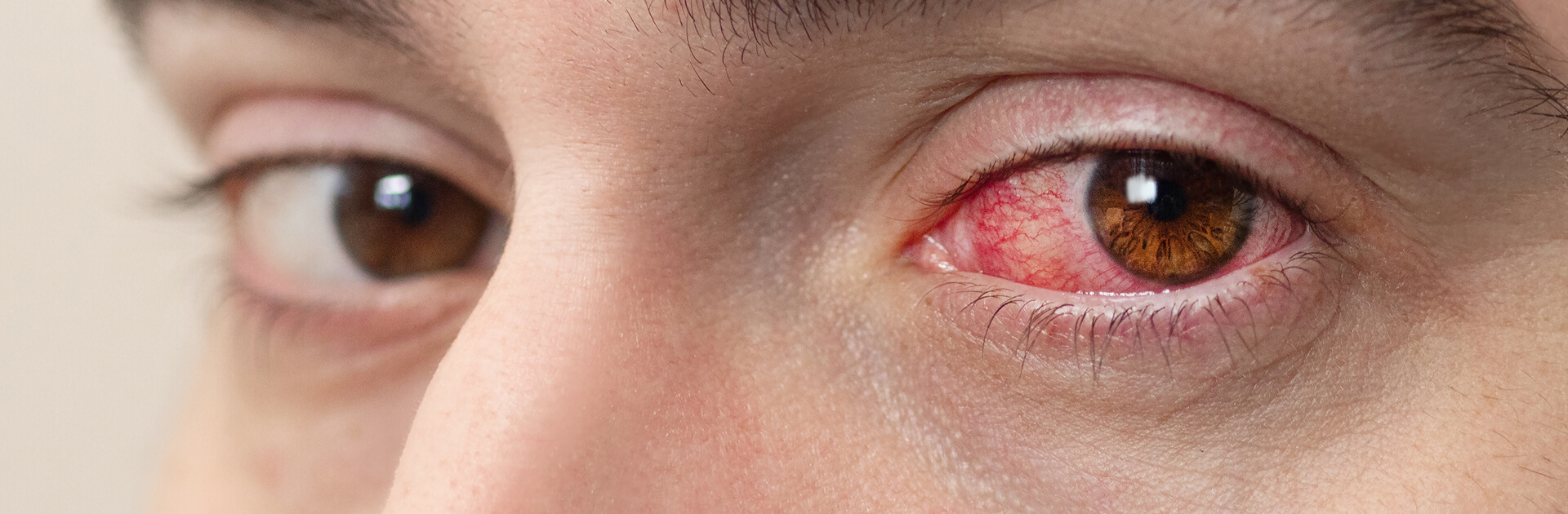 Conjuntivitis
